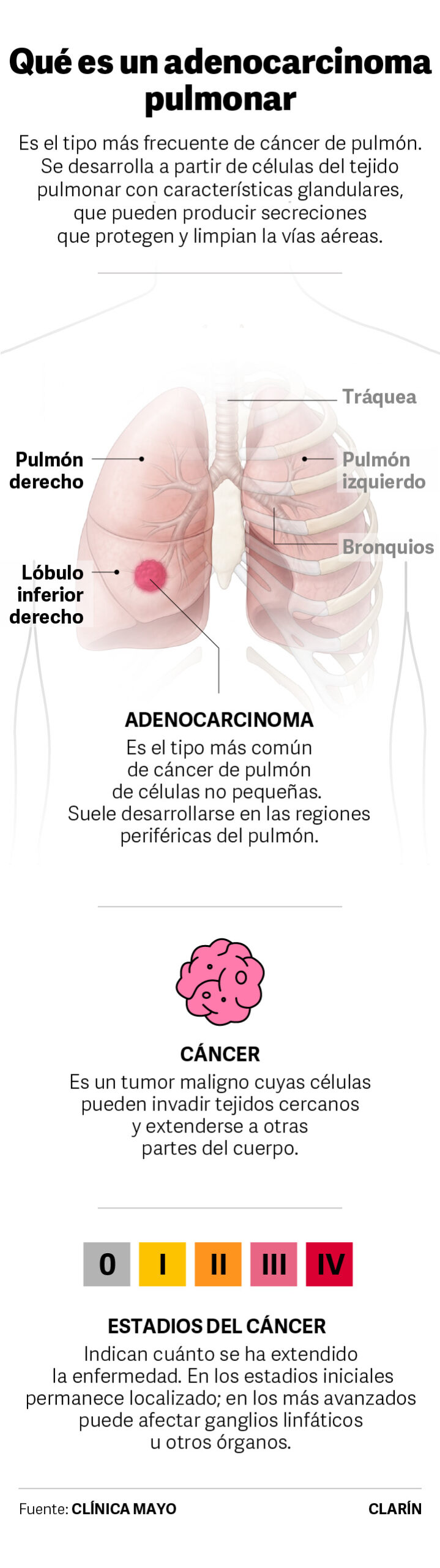 Adenocarcinoma pulmonar